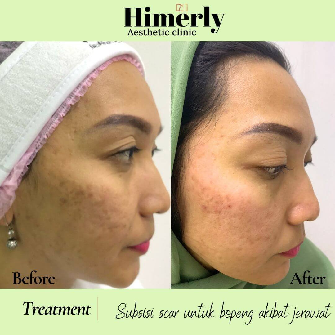 Tindakan Dokter Himerly Aesthetic Clinic and Beautybar – Subsisi Scar Bopeng Jerawat